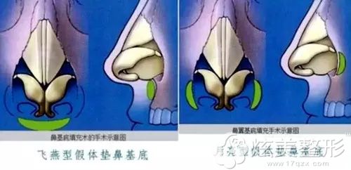 兰州时光推荐假体填充鼻基底 兰州时光推荐假体填充鼻基底