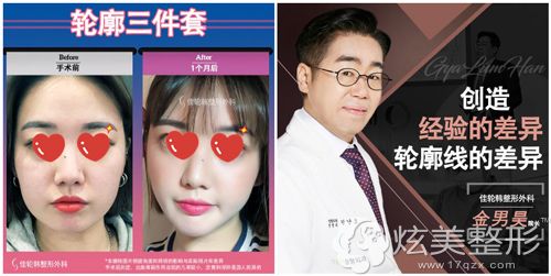 韩国佳轮韩做面部轮廓术前术后对比 韩国佳轮韩做面部轮廓术前术后对比