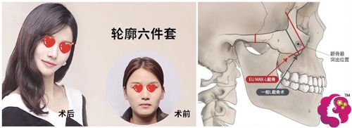 韩国EU整形轮廓楼剑涛术后面部变小 韩国EU整形轮廓楼剑涛术后面部变小