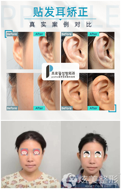 郑在皓院长贴发耳矫正案例 郑在皓院长贴发耳矫正案例