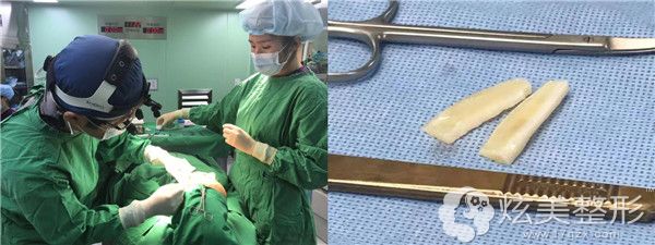 禾禾做贴发耳矫正整形过程中 禾禾做贴发耳矫正整形过程中