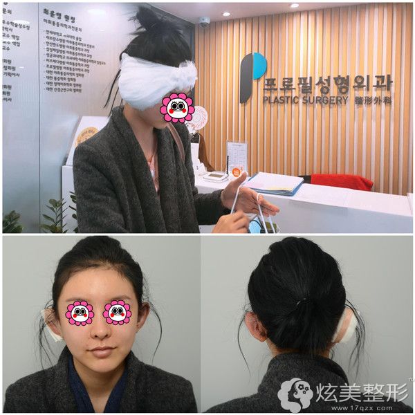 到韩国普罗菲耳做贴发耳整形术后恢复中 到韩国普罗菲耳做贴发耳整形术后恢复中
