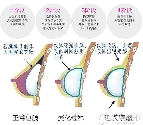 包膜挛缩根据<span alt=