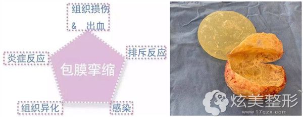 对于3、4级的包膜挛缩要取出假体清除包膜 对于3、4级的包膜挛缩要取出假体清除包膜