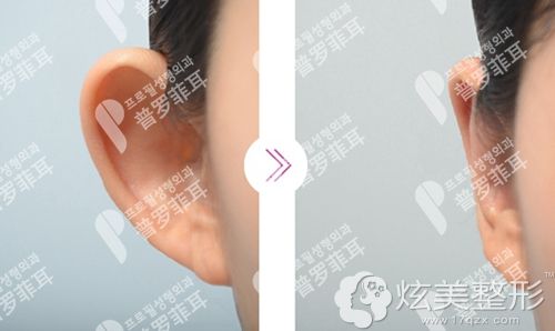 韩国普罗菲耳招风耳矫正前后对比案例 韩国普罗菲耳招风耳矫正前后对比案例