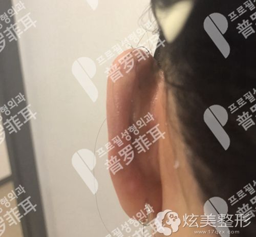 招风耳整形半年后疤痕几乎看不到 招风耳整形半年后疤痕几乎看不到