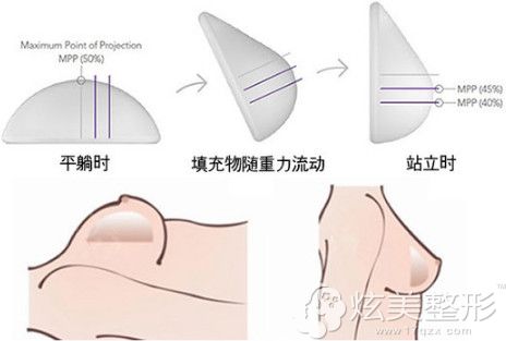 博朗温魔滴motive假体隆胸手术过程 博朗温魔滴motive假体隆胸手术过程