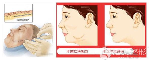 埋线提升前后对比<span alt=