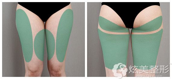 大腿吸脂的部位展示 大腿吸脂的部位展示