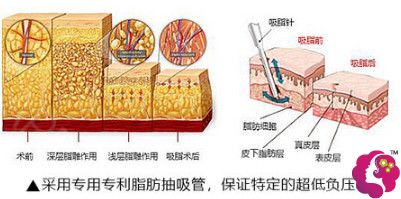 福州比华利刘耀美医师采用分层吸脂术 福州比华利刘耀美医师采用分层吸脂术