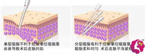 比华利整形医院采用分层吸脂术瘦身安全有效 比华利整形医院采用分层吸脂术瘦身安全有效