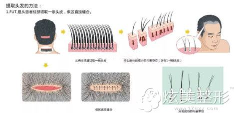 彭亿医生采用UR-FUE超精细无痕植发技术植发效果显著 彭亿医生采用UR-FUE超精细无痕植发技术植发效果显著