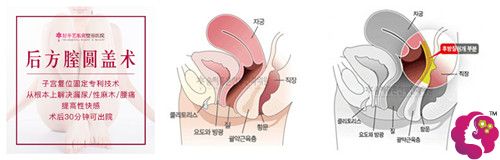韩国好手艺尹虎珠院长做后方膣圆盖术过程 韩国好手艺尹虎珠院长做后方膣圆盖术过程