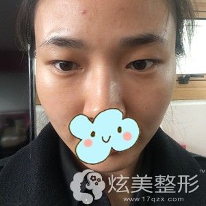 到清潭first面诊前单眼皮的自己 到清潭first面诊前单眼皮的自己