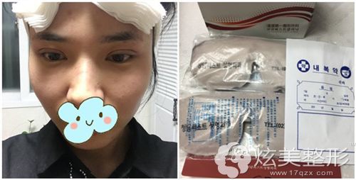 在清潭first做初次双眼皮术后即刻 在清潭first做初次双眼皮术后即刻