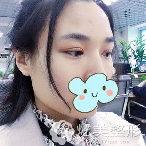 成镇模帮我做初次双眼皮术后7天拆线后 成镇模帮我做初次双眼皮术后7天拆线后