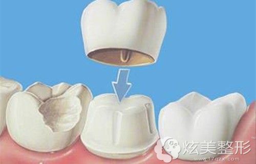 美容冠改善牙齿不齐的手术原理图 美容冠改善牙齿不齐的手术原理图