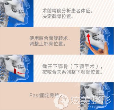 必妩整形医院第四代纳米双颚手术特点 必妩整形医院第四代纳米双颚手术特点