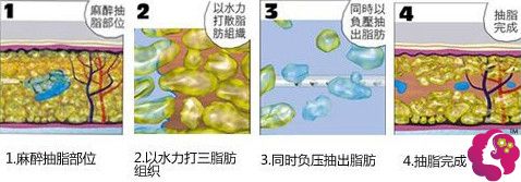 金英杓院长做水动力吸脂手术过程 金英杓院长做水动力吸脂手术过程