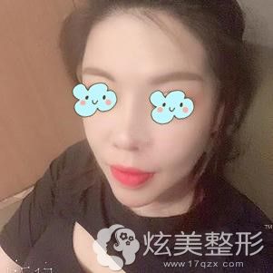 到韩国菲斯莱茵做双鄂+轮廓四件套术后92天恢复效果 到韩国菲斯莱茵做双鄂+轮廓四件套术后92天恢复效果