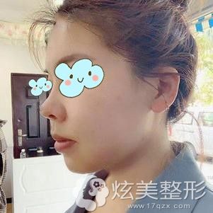 李真秀做双鄂+轮廓四件套术后28天基本看不出手术痕迹 李真秀做双鄂+轮廓四件套术后28天基本看不出手术痕迹