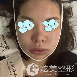 做双鄂手术+轮廓手术术后5天肿胀基本消除 做双鄂手术+轮廓手术术后5天肿胀基本消除