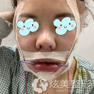 李院长帮我做双鄂+轮廓四件套术后即刻 李院长帮我做双鄂+轮廓四件套术后即刻