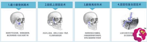 无切除颧骨提升缩小术手术示意图 无切除颧骨提升缩小术手术示意图