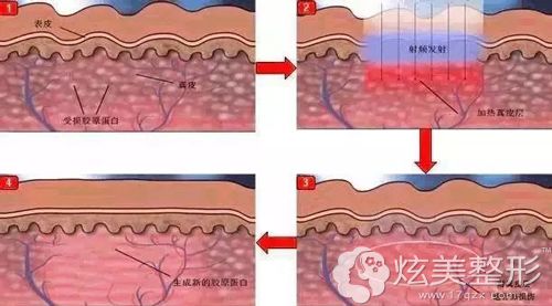 光子嫩肤修复皮肤角质层的示意图 光子嫩肤修复皮肤角质层的示意图