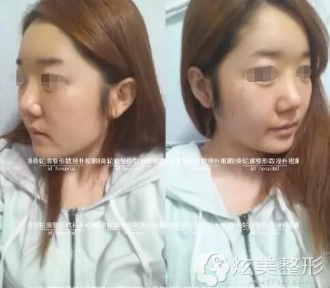 做鼻子再手术+面部不对称整形后 她力破韩国ID不靠谱传言