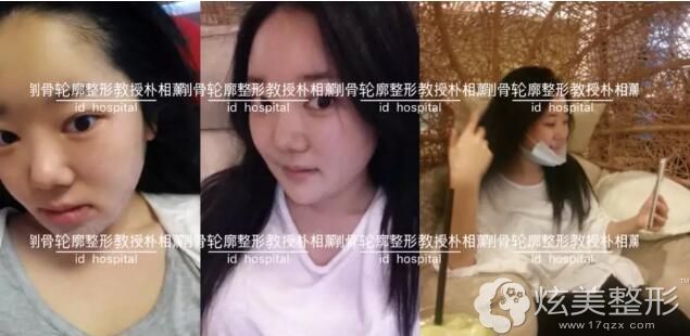 做完鼻子再手术+面部轮廓整形术后一周 做完鼻子再手术+面部轮廓整形术后一周