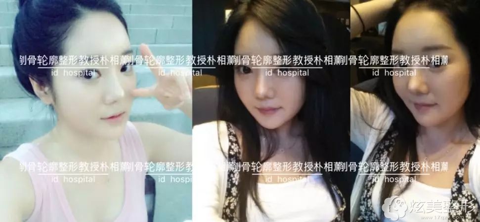 做过整形术后一个月妮妮的蜕变效果 做过整形术后一个月妮妮的蜕变效果