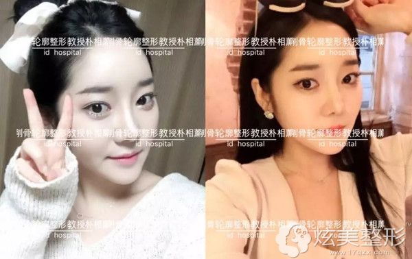 在韩国ID做脸型的改变再加上鼻子再手术术后十个月效果 在韩国ID做脸型的改变再加上鼻子再手术术后十个月效果