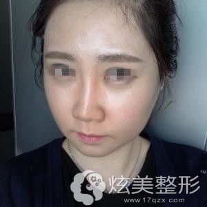朴原辰做颧骨内推手术后10天有点微肿 朴原辰做颧骨内推手术后10天有点微肿