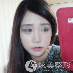 在韩国原辰做颧骨内推1个月脸型有改变 在韩国原辰做颧骨内推1个月脸型有改变