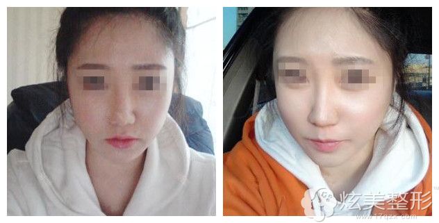 朴原辰院长做完颧骨内推手术2个月恢复小V脸 朴原辰院长做完颧骨内推手术2个月恢复小V脸