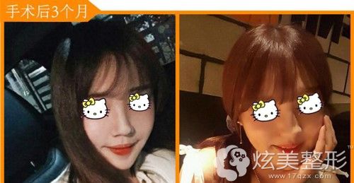 李院长做下颌角缩小术术后3个月面部明显变小 李院长做下颌角缩小术术后3个月面部明显变小