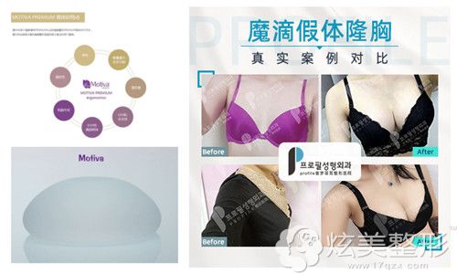 普罗菲耳整形医院做魔滴假体隆胸案例 普罗菲耳整形医院做魔滴假体隆胸案例
