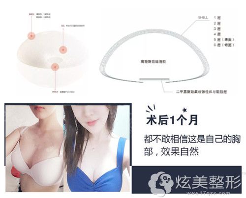 原辰整形外科医院做蓓拉假体隆胸案例 原辰整形外科医院做蓓拉假体隆胸案例