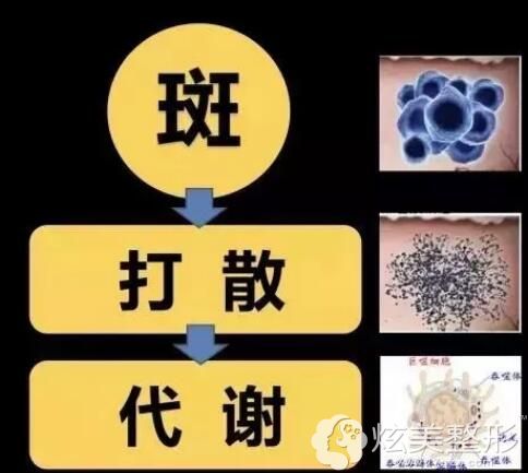 超皮秒祛斑的作用原理 超皮秒祛斑的作用原理