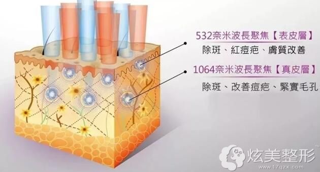 超皮秒祛斑的常见波长分享 超皮秒祛斑的常见波长分享