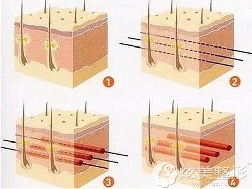 做埋线提升手术的步骤原理图 做埋线提升手术的步骤原理图