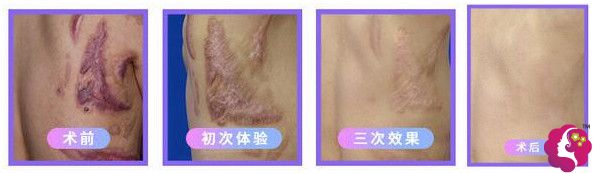 8850元起去除的烫伤瘢痕案例 8850元起去除的烫伤瘢痕案例