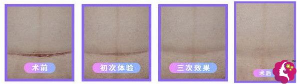 在正璞花了六千多去除自己的剖腹产疤痕 在正璞花了六千多去除自己的剖腹产疤痕