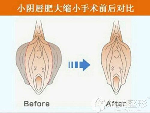 尹虎珠院长做阴唇整形术前后对比 尹虎珠院长做阴唇整形术前后对比