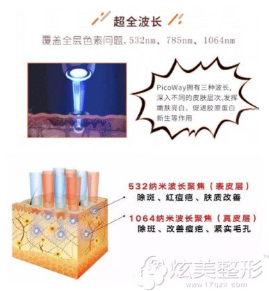 薇琳整形医院超皮秒祛斑有不同波长 薇琳整形医院超皮秒祛斑有不同波长