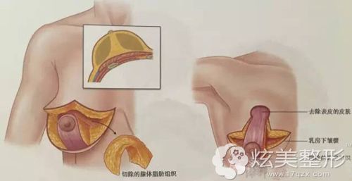 垂直双蒂法改善胸部下垂矫正的示意图 垂直双蒂法改善胸部下垂矫正的示意图