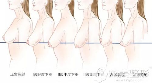不同程度的乳房下垂示意图 不同程度的乳房下垂示意图