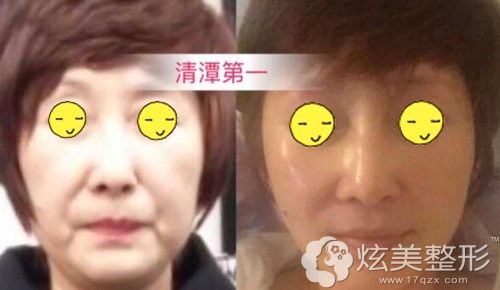 清潭first为数不多的纵深肌理归位术真人案例 清潭first为数不多的纵深肌理归位术真人案例