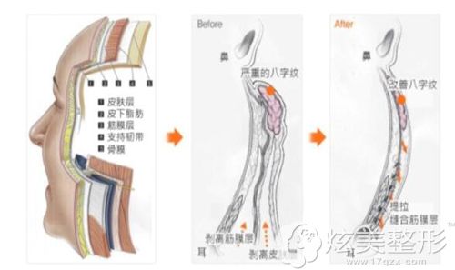 成镇模院长讲述纵深肌理归位术的示意图 成镇模院长讲述纵深肌理归位术的示意图